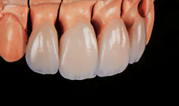 Dentes-de-porcelana