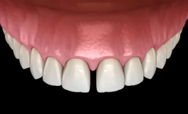 Diastema espaço entre os dentes anteriores