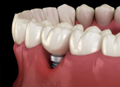 Peri-implantite-inflamação-ao-redor-do-implante-dentário