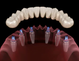 Prótese-fixa-sobre-implantes-dentários