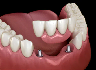 Prótese-parcial-fixa-dento-gengival-sobre-implantes-dentarios