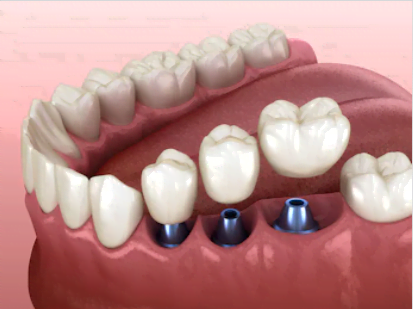 Próteses-unitárias-sobre-implantes-dentários