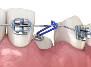 botões-ortodonticos-para-aparelhos-dentários