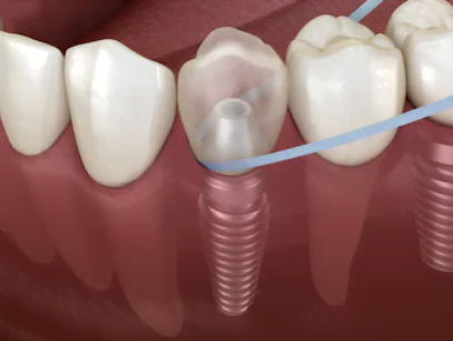  limpeza-das-próteses-sobre-implantes-dentários
