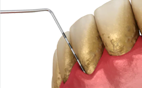 tratamento-da-periodontite-Sondagem-de-bolsa-periodontal