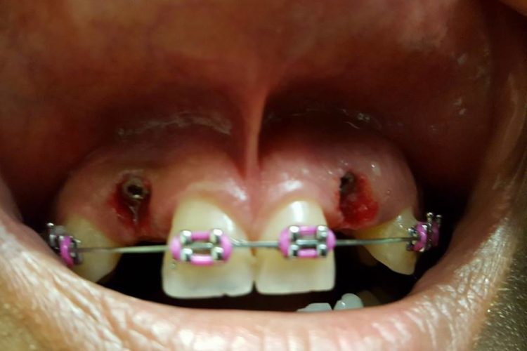 Implantes dentários mal posicionados