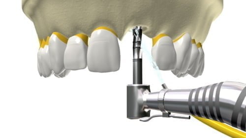 perfuraca-para-instalacao-do-implante-dentario