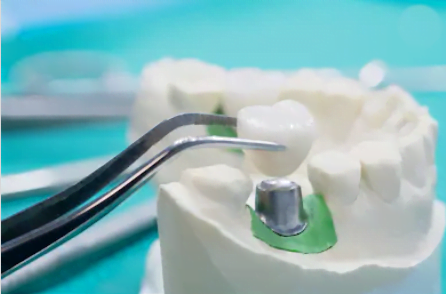 Pilar personalizado para próteses sobre implantes dentário