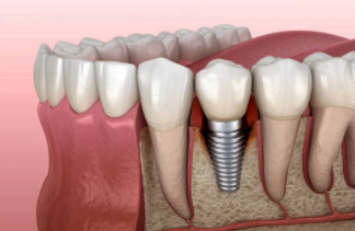 Problemas-com-implantes-dentarios